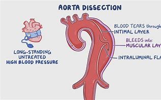 Aortic Dissection | Etiology, Pathophysiology, Diagnosis, Clinical Features, Treatment cc_490