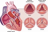 Aortic Valve Stenosis & Regurgitation cc_491